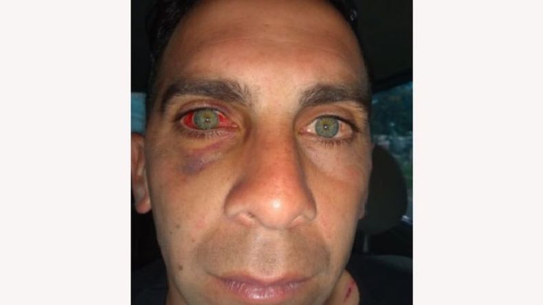 SECUELAS. Pace muestra cómo quedó su ojo..