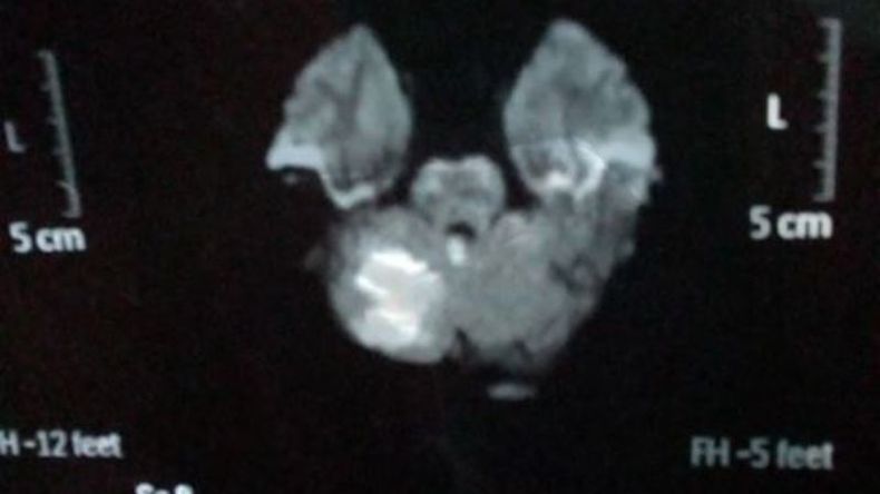 Diagnóstico. Tras realizarle una tomografía, le confirmaron que había tenido un ACV isquémico. .