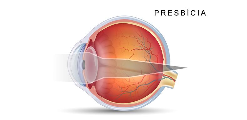 Presbicia. (clinicavejamoreno.com.ar).