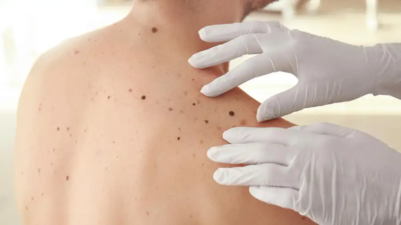 La detección precoz de lesiones cutáneas es fundamental para prevenir el cáncer de piel.&nbsp;