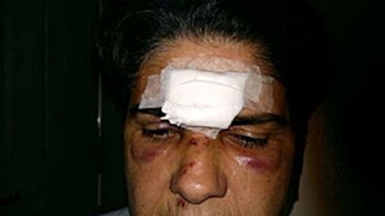 HERIDA. Teresa muestra los rastros del golpe recibido..
