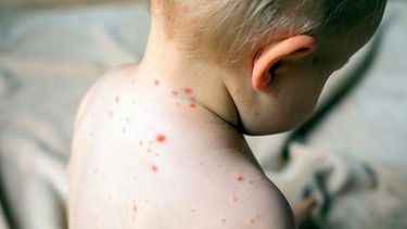 Alerta por dos nuevos casos autóctonos de sarampión