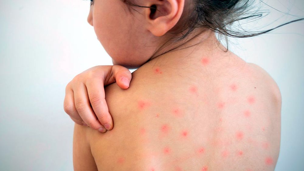 La caída en las tasas de vacunación preocupa a las autoridades sanitarias que temen por un posible brote de la enfermedad. &nbsp;