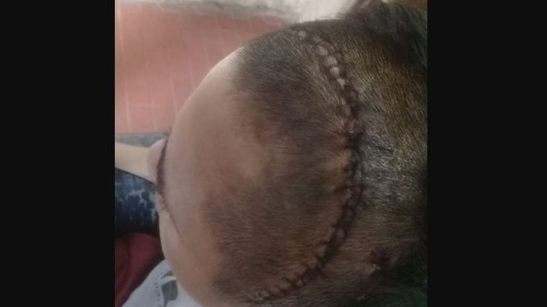 IMPACTANTE. Así quedó Juan luego de su operación..