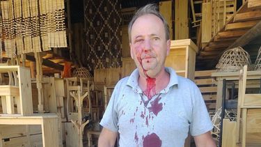 HERIDO. La víctima sufrió un golpe en el rostro.