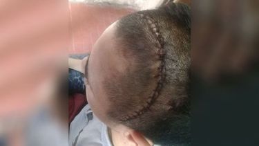 CICATRIZ. Juan tiene 30 puntos en la cabeza..