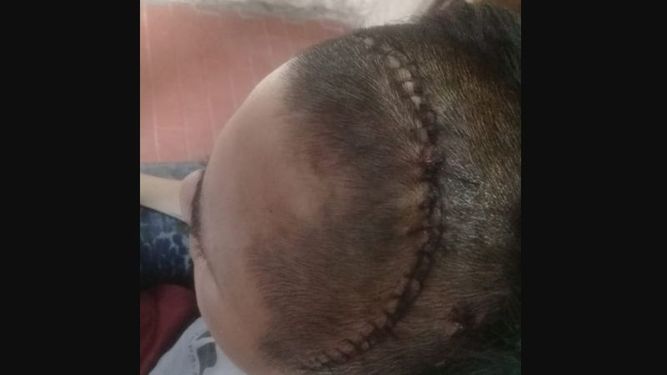 IMPACTANTE. Así quedó Juan luego de su operación..