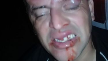 Luis Da Silveira terminó con el rostro desfigurado..