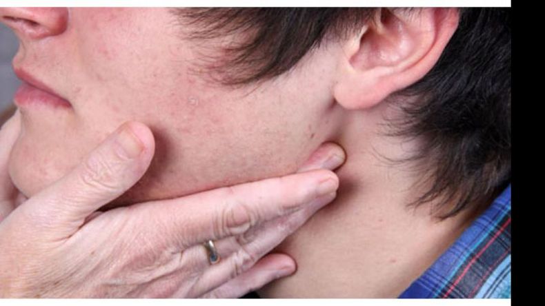 Síntomas: Fiebre, hinchazón de glándulas salivares, sordera, inflamación de testículos u ovarios. Contagio: Saliva y secreciones de la nariz. Incubación: 2-3 semanas. Vacunación: incluida en la triple viral..