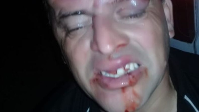 Luis Da Silveira terminó con el rostro desfigurado..