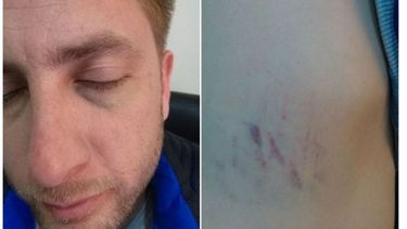 GOLPES. El rostro del concejal Pérez, con las marcas de la violencia..