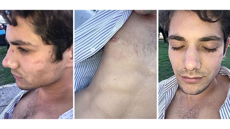 VIOLENCIA. Facundo Fernández denunció que el policía le rompió la nariz..