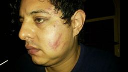 GOLPEADO. Sergio Rodríguez muestra las consecuencias de los golpes recibidos en el rostro y cabeza..